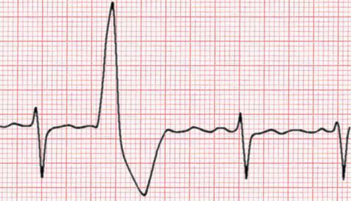 ventricular extrasystole